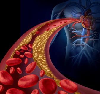 Medical illustration of restricted artery flow near the heart